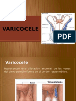 Varicocele