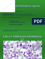 Leucemia Linfoblastica Aguda