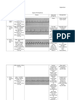 Types of Arrhythmia