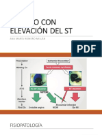 Infarto Con Elevación Del ST