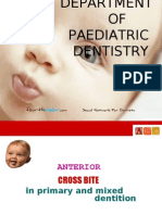 Anterior Cross Bites in Primary Mixed Dentition Pedo