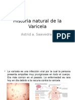 Historia Natural de La Varicela