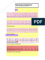 Cardiovascular SYSTEM - Heart Dysrythmia Illustrations