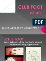 Club Foot