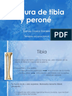 Fractura de Tibia y Peroné