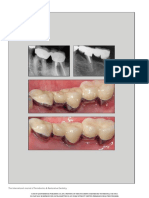 Root Resection and Hemisection Revisited. Part II - A Retrospective Analysis of 195 Treated Patients With Up To 40 Years of Follow-Up