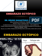 3 - Embarazo Ectopico PDF