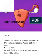 Ectopic