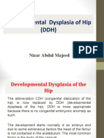 Developmental Dysplasia of Hip (DDH) : Nizar Abdul Majeed