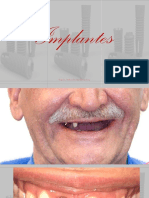 Implantes Dentales