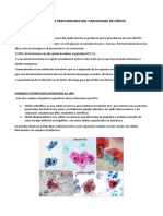 Lesiones Precursoras Del Carcinoma de Cérvix: Infección Por HPV