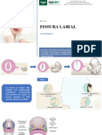 Fissura Labial 1