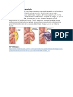 Hernia Inguinal Encarcelada