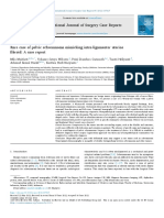 Rare Case of Pelvic Schwannoma Mimicking Intra-Ligamenter Uterine Fibroid A Case Report