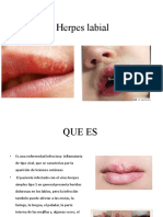 Herpes Labial