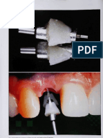 文獻2 Custom impression coping for an exact registration of the healed tissue in the esthetic implant restoration 