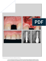 Incision Design and Soft Tissue Mangement To Maintain or Establish An Interproximal Papilla Around Integrated Implants A Case Series