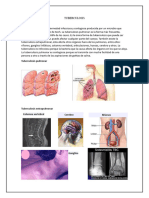 Tuberculosis