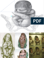 Breech Presentation