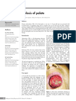 Primary Tuberculosis of Palate