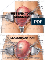 Histerectomia Abdominal