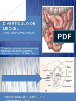 Diverticulo de Meckel