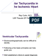 Ventricular Tachycardia in The Ischemic Heart