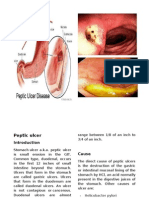 Peptic Ulcer Print