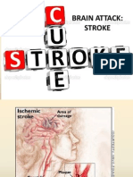 Brain Attack: Stroke