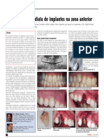 Colocação Imediata de Implantes Na Zona Anterior - White Clinic