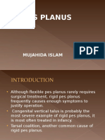 Pes Planus by MI