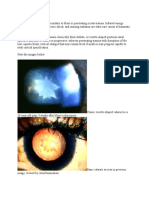 Traumatic Cataracts Occur Secondary To Blunt or Penetrating Ocular Trauma