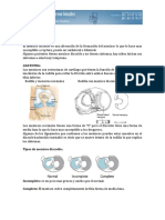 Menisco Discoide