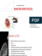 Toracocentesis