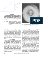 Syndrome After Posterior Chamber Lens Implantation