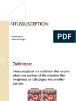 Intussusception: Prepared By: Aisha H. Alagha