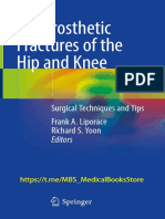 Periprosthetic FRACTURES