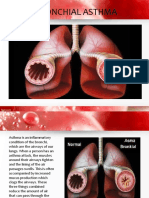 Bronchial Asthma