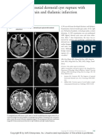 Intracranial Dermoid Cyst Rupture With Midbrain and Thalamic Infarction