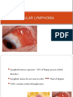 Ocular Lymphoma