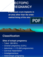 Ectopic Pregnancy