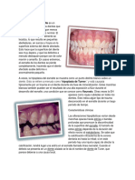 Hipoplasia Del Esmalte