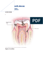 Cavities