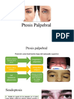 Ptosis Palpebral