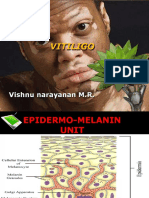 Vitiligo: Vishnu Narayanan M.R