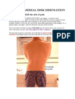 Postromedial Dic Prolaps