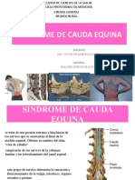 Sindrome de Cauda Equina