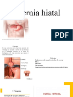 Hernia Hiatal