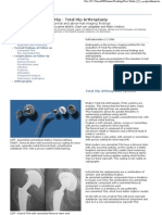 Hip - Total Hip Arthroplasty