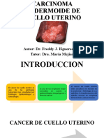 Carcinoma Epidermoide de Cuello Uterino 2